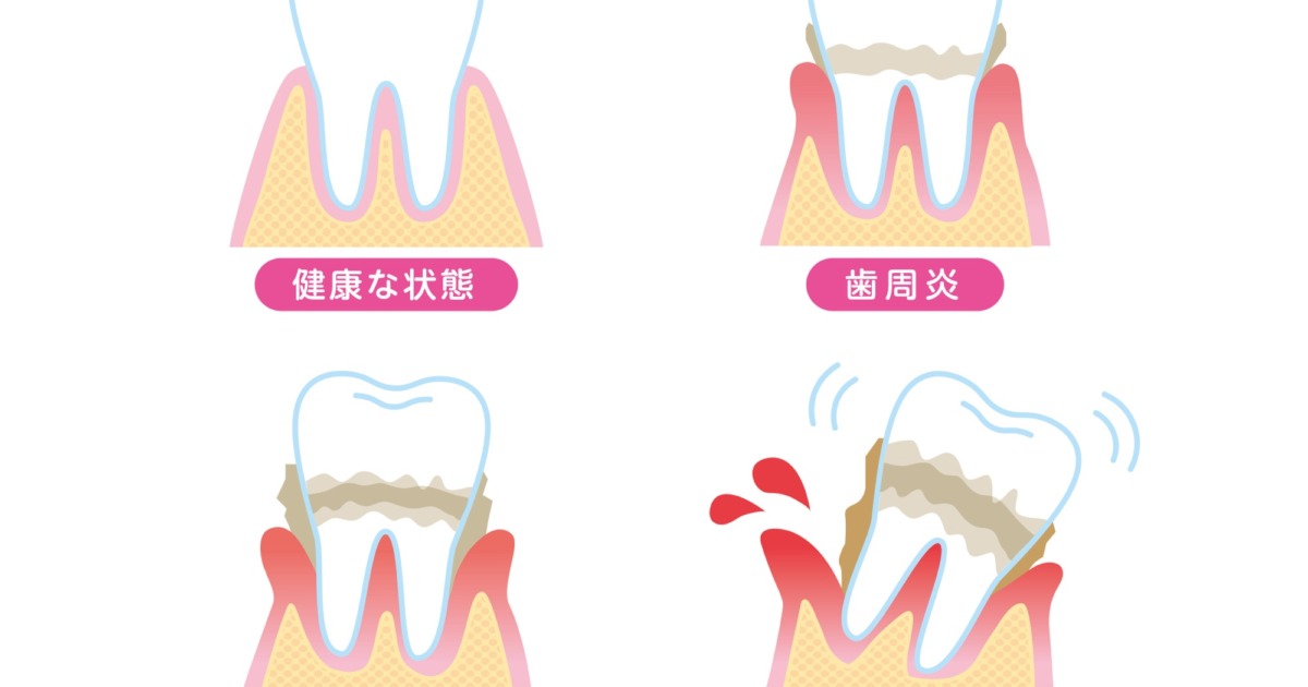 歯周病は治るの？？｜スタッフブログ｜痛みの少ない歯医者さん
